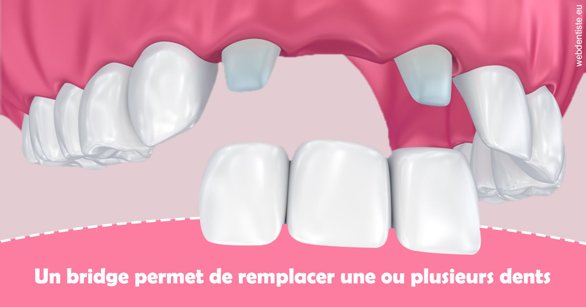 https://dr-deruelle-frederic.chirurgiens-dentistes.fr/Bridge remplacer dents 2