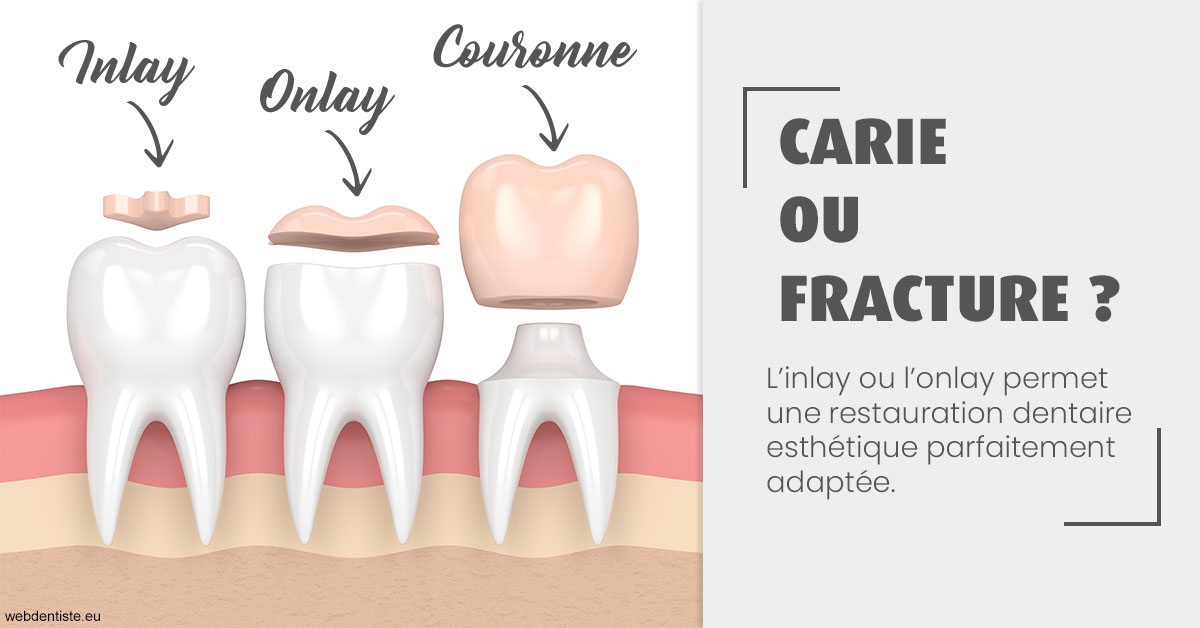 https://dr-deruelle-frederic.chirurgiens-dentistes.fr/T2 2023 - Carie ou fracture 1
