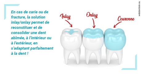 https://dr-deruelle-frederic.chirurgiens-dentistes.fr/L'INLAY ou l'ONLAY