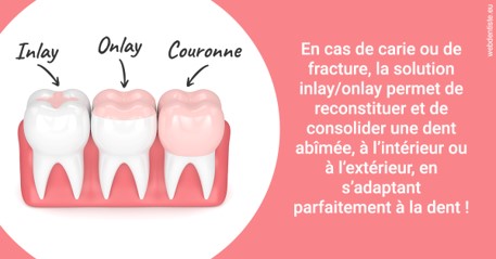 https://dr-deruelle-frederic.chirurgiens-dentistes.fr/L'INLAY ou l'ONLAY 2