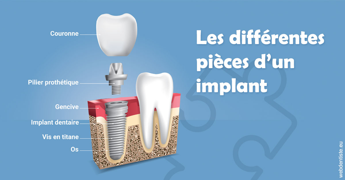 https://dr-deruelle-frederic.chirurgiens-dentistes.fr/Les différentes pièces d’un implant 1