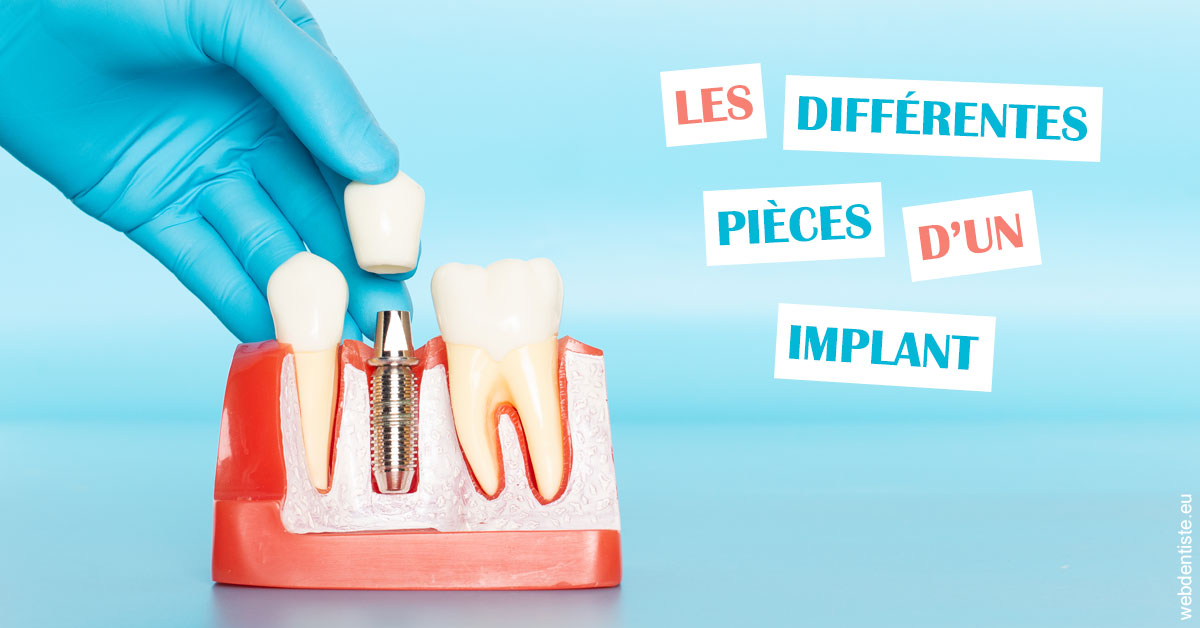 https://dr-deruelle-frederic.chirurgiens-dentistes.fr/Les différentes pièces d’un implant 2